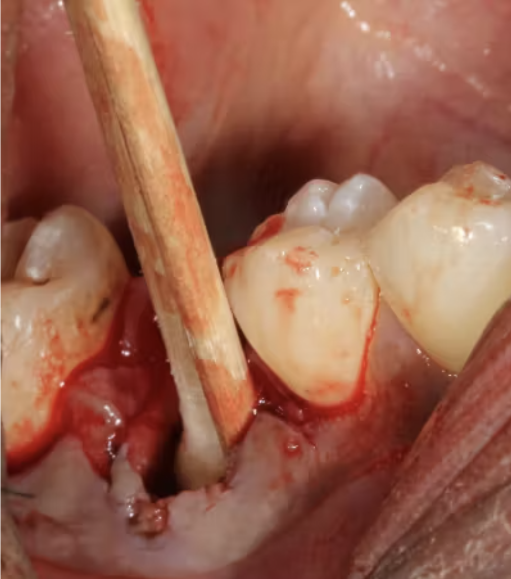 Nguyên tắc vàng khi tái cấy implant sau thất bại